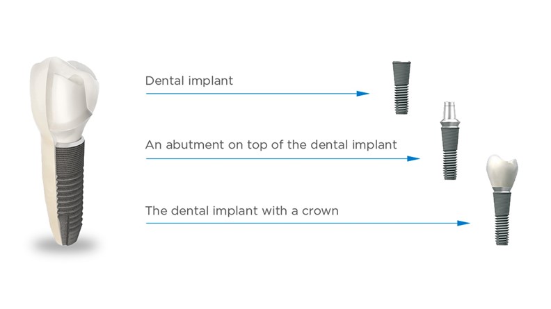 Ringsted Tandklinik - Hvad er en tandimplantat
